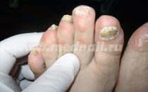 До лечения грибка ногтей