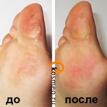 педикюрные носочки до и после