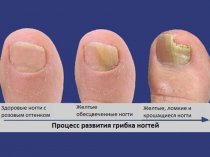 Профилактика грибка ногтей на ногах или онихомикоза